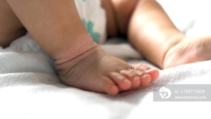 Close-up of the folds of the foot of a newborn baby with red skin. Atopic dermatitis of children’s skin. Prickly heat. diaper rash.