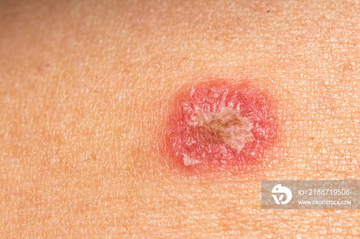 Ring Worm infection, Dermatophytosis on skin