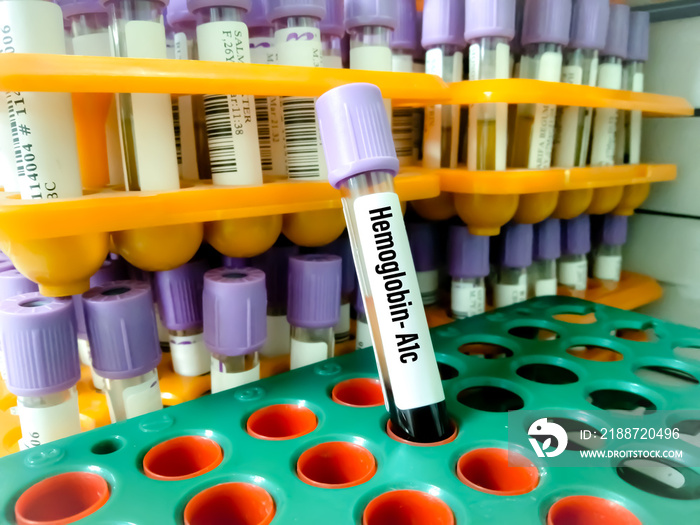 Laboratory sample tube of glycalated hemoglobin or hemoglobin A1C test(HbA1C). This blood sugar level used for diagnosis Diabetes mellitus disease(DM) and glycemic control in patient. Medical concept