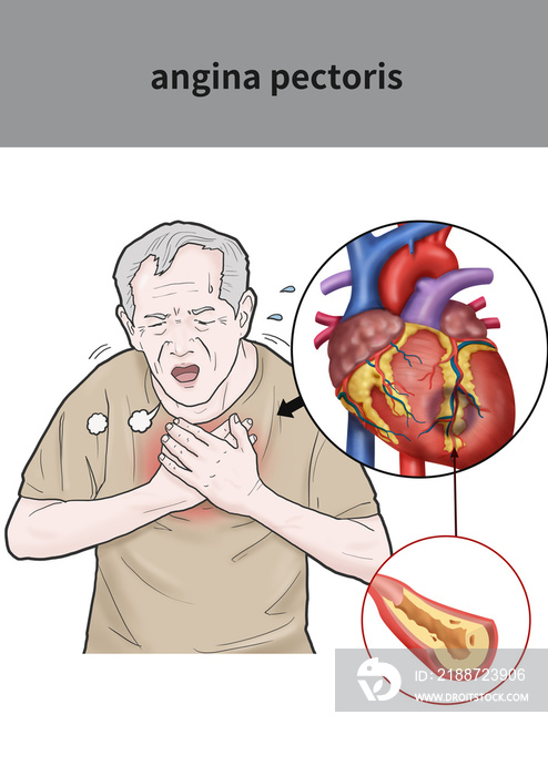 Medical illustration for explanation angina pectoris