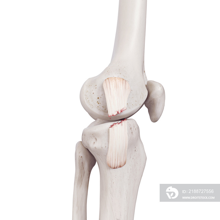 3d rendered medically accurate illustration of a torn tibial collateral ligament