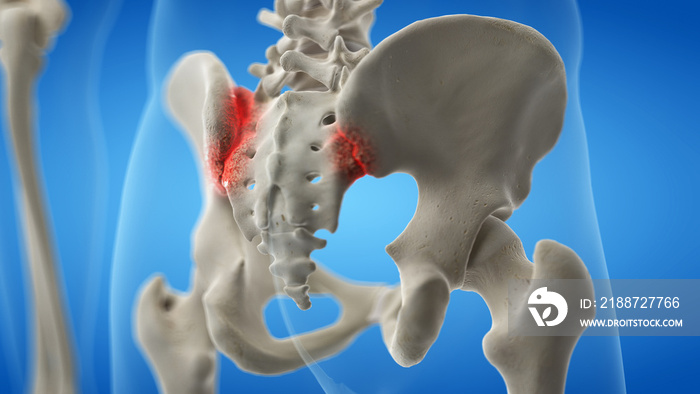 3d rendered medically accurate illustration of an arthritic iliosacral joint