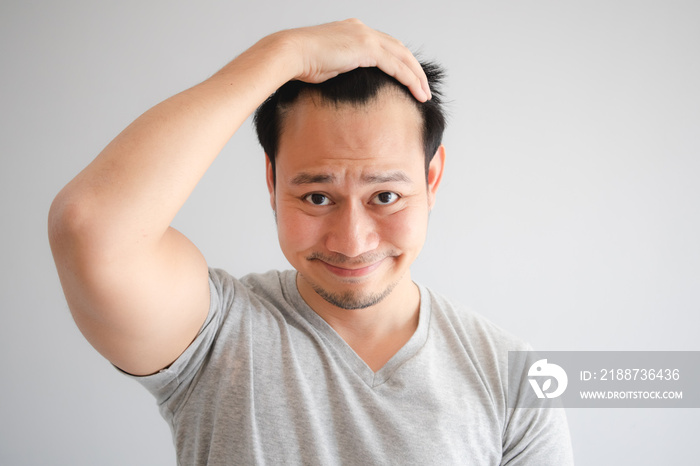 Shocked face of Asian man find himself lost hair and get bald.