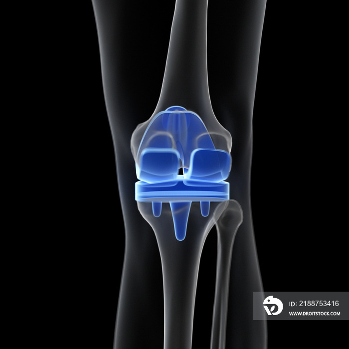 3d rendered medically accurate illustration of a knee replacement