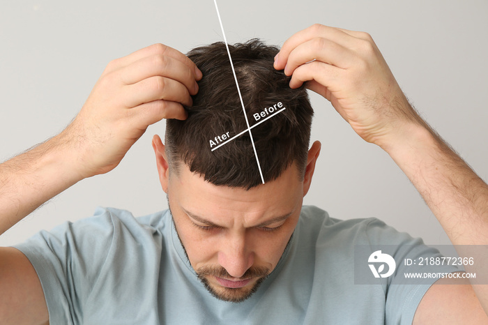 Man before and after hair loss treatment on grey background