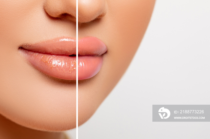 Closeup lips comparison, chapped rough lips and healthy, smooth moisturized lips. copy space. Beauty Portrait lips Closeup. Pink color. make-up.