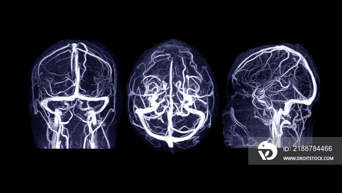 MRV Brain or magnetic resonance venography of The Brain for abnormalities in venous drainage of the brain