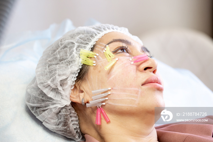 Thread lifting is a cosmetological procedure for face rejuvenation. The beautician implants cosmetic threads under the skin to relieve facial ptosis.