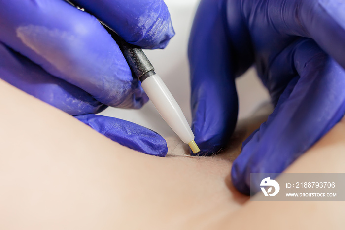 macro photography working doctor electrolysis using an electrode and tweezers permanent hair removal procedure