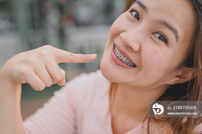 Smiling Asian woman wearing orthodontic retainer. Dental care and healthy teeth.