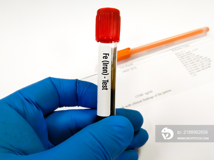 Biochemist or Lab Technologist holds Blood sample for Transferrin test. Iron deficiency anemia,TIBC.