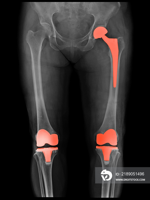 接受髋关节置换术和膝关节置换术（膝关节置换）治疗的患者的X射线扫描