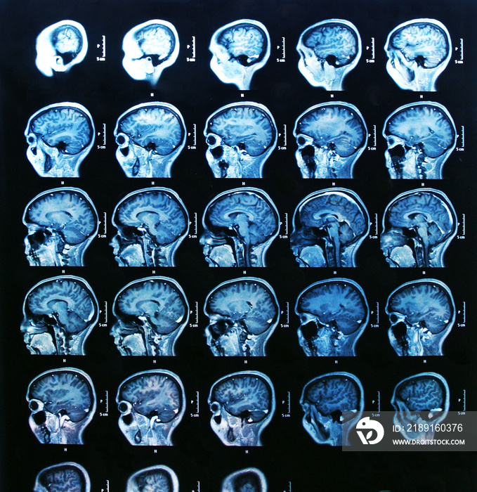 IRM du cerveau