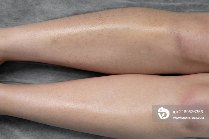 Image before and after concept of hair removal on female legs in a beauty salon.