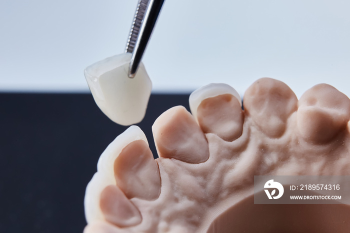 Ceramic dental veneers. Close-up view of dental layout of lower row of teeth prothesis on artificial