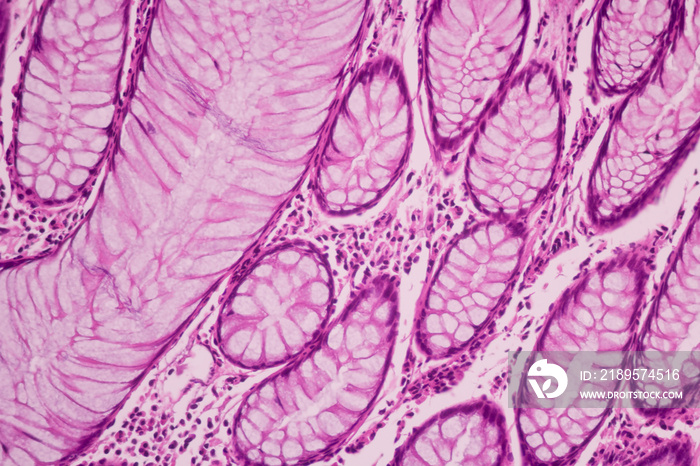 乳腺导管细胞癌、人乳腺癌症腺癌、组织切片显微镜观察