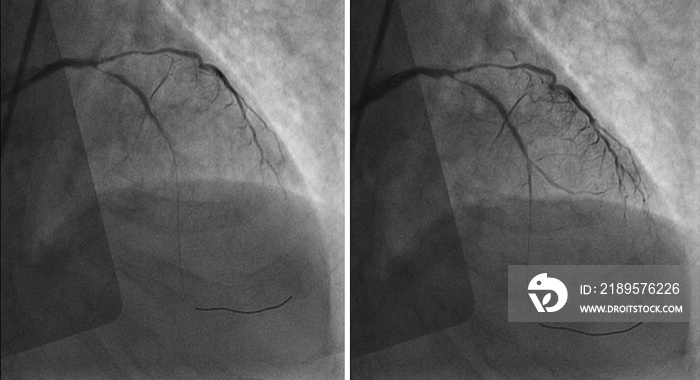 Catheterization. Cardiac ventriculography is a medical imaging test used to determine a patient card