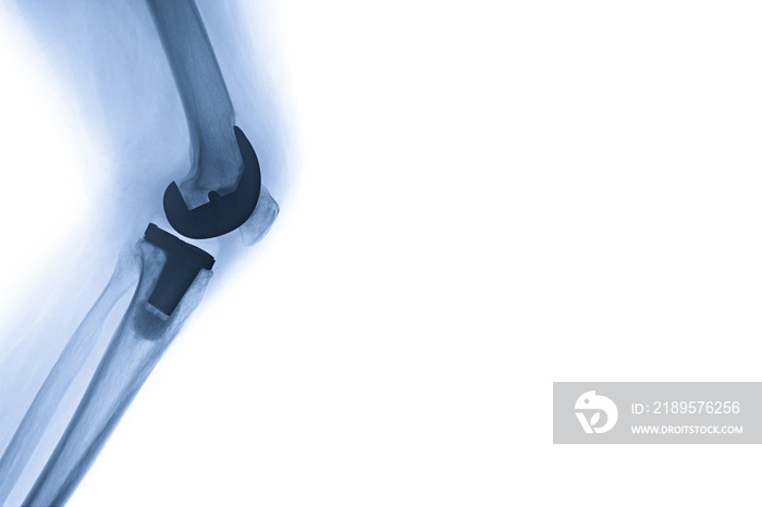 全膝关节置换，具有文本和横幅、网站和打印使用空间