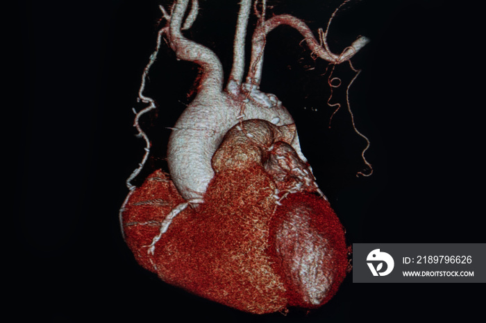 X射线医学扫描医院心脏。CTA，CT血管造影术3D渲染图像，CT扫描。医疗保健