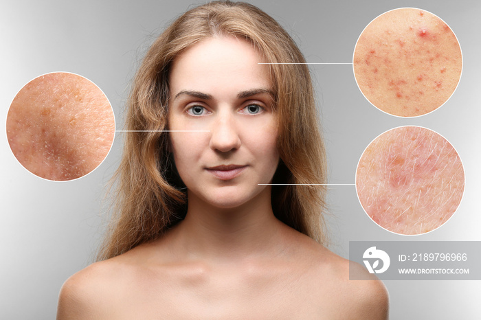 Acne and skin care concept. Young woman before and after cosmetic procedure on gray background