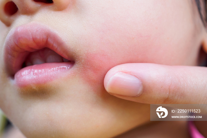 mother applying topical antihistamine cream at kid face with skin rash and allergy with red spot cau