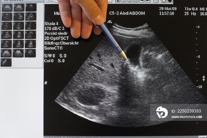 Ultraschall von Gallensteinen