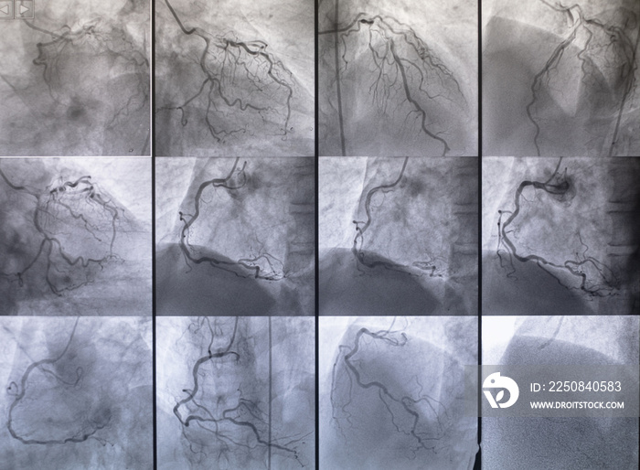 冠状动脉造影，心脏病的医学x光。冠状动脉疾病。