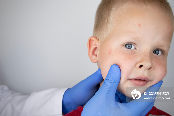 An allergist or dermatologist examines red spots on a child’s face. The boy suffers from a rash, hiv