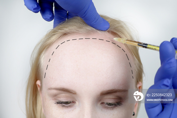 Hair mesotherapy or hair transplant: a beautician doctor makes injections in the head of a woman for