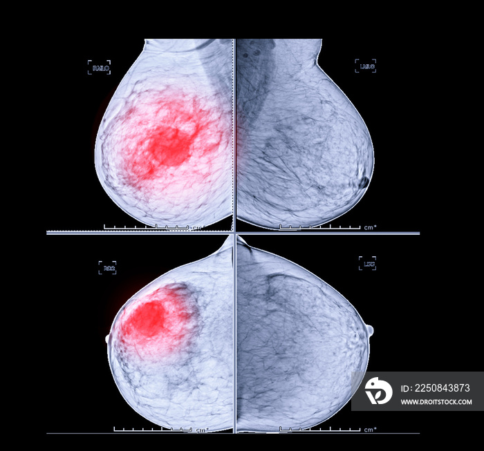 X-ray Digital Mammogram both side CC view and MLO . mammography or breast scan for Breast cancer sho