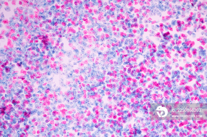 Normal squamous epithelial cells of cervical human view in microscopy.Cytology criteria from pap sme