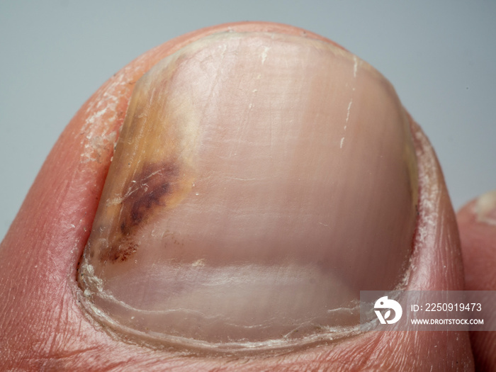 Nail infections caused by fungi such as: onychomycosis also known as tinea unguium. Thumb infection.