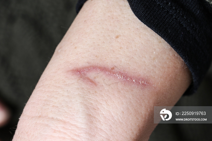 Closeup of healing burn scar on human forearm