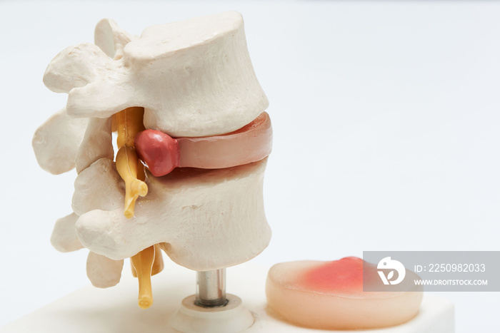 白底人工腰椎间盘突出症