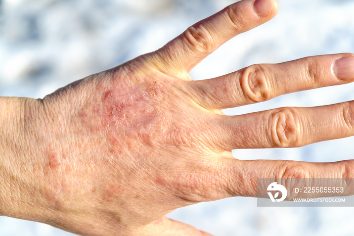 Detailed closeup of dry mature woman hand