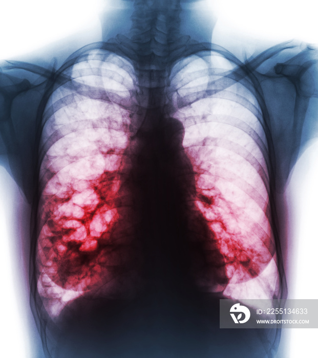 Bronchiectasis .  X-ray chest show multiple lung bleb and cyst due to chronic infection . Front view