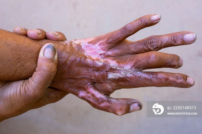 The hand of an accidentally disabled person,Hand scar, wrinkled skin, dirty hands