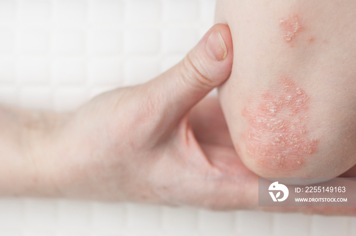 psoriasis on the skin of the elbow of a young woman in a white T-shirt. close-up