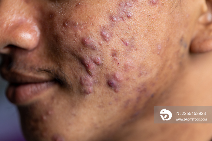 Backgrounds of lesions skin caused by acne on the face in the clinic.