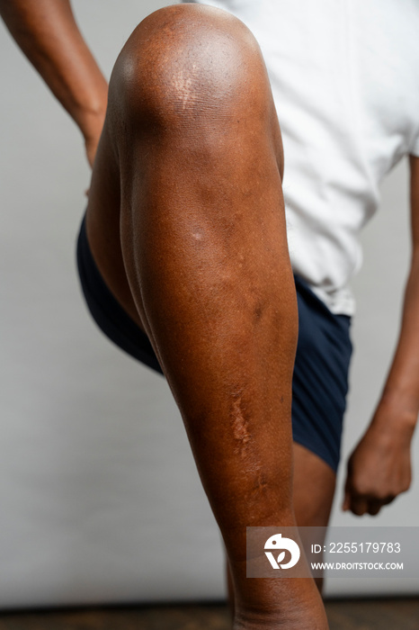 Man showing leg with scars against gray background