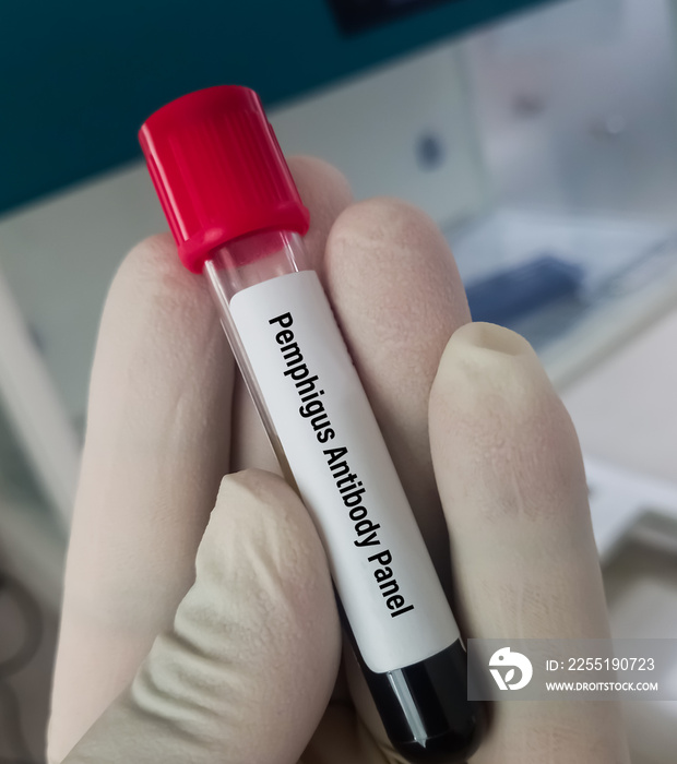 Hand holding blood sample for Pemphigus antibody panel, Pemphigus is an uncommon autoimmune blistering disease.