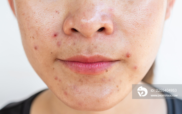 Cropped shot of woman having problems of acne inflamed on her face. Inflamed acne consists of swelling, redness, and pores that are deeply clogged with bacteria, oil, and dead skin cells.