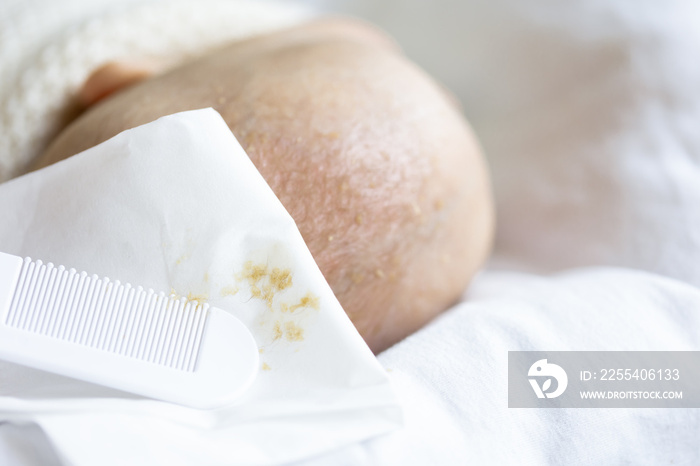 some flakes of seborrheic crusts from baby’s head on white tissue with comb and infant head on the foreground