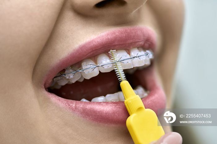 Closeup view at female teeth with bracket system