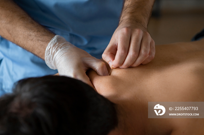 Midsection of hands in gloves Of Physical Therapist or doctor performing a dry needling treatment to a shirtless male patient in back pain.