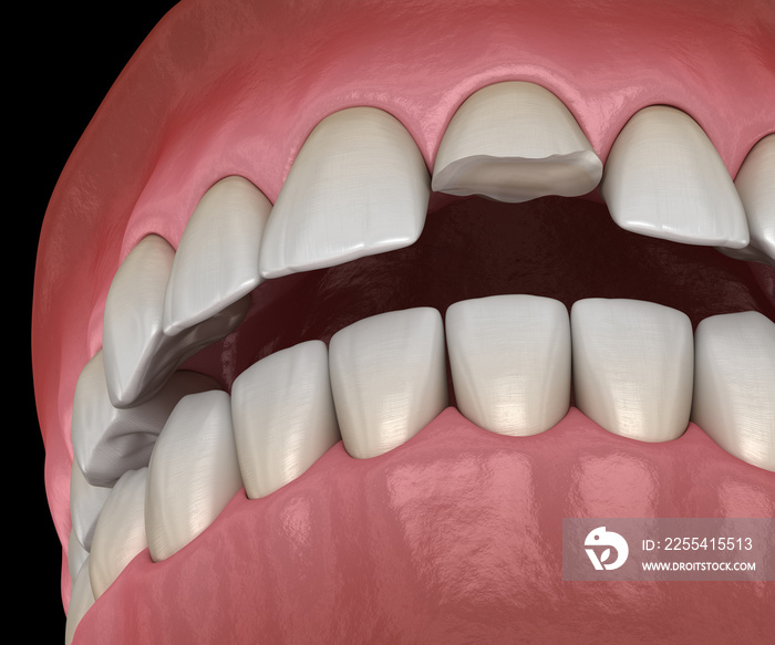 Broken central incisor tooth. Medically accurate 3D illustration of human teeth and dentures concept