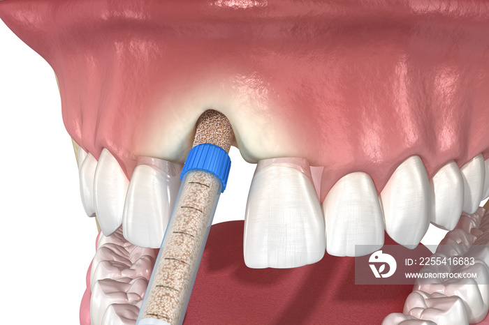 Bone grafting augmentation, socket preservation, tooth implantation. Medically accurate 3D illustration.