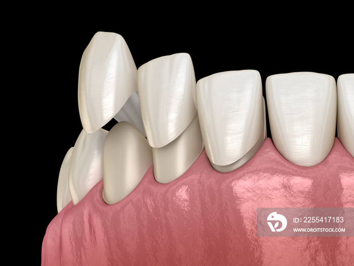 Veneer installation procedure over central incisor and lateral incisors. Medically accurate tooth 3D illustration