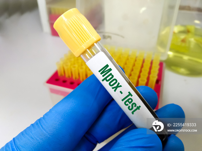 Blood sample for Monkeypox virus test. It has been rebranded ’mpox’ by the World Health Organisation (WHO)