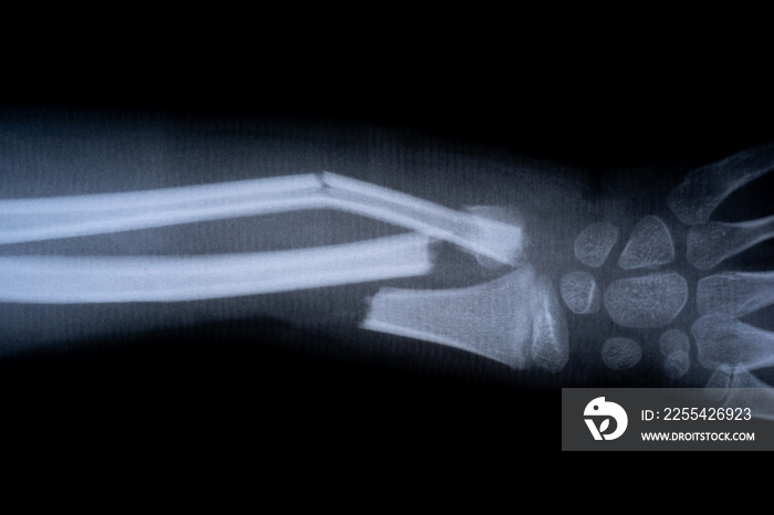 x-ray film skeleton human arm. health medical anatomy body concept